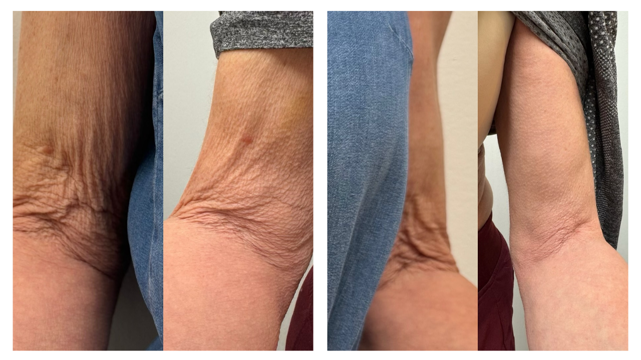 My Arms with Radiesse