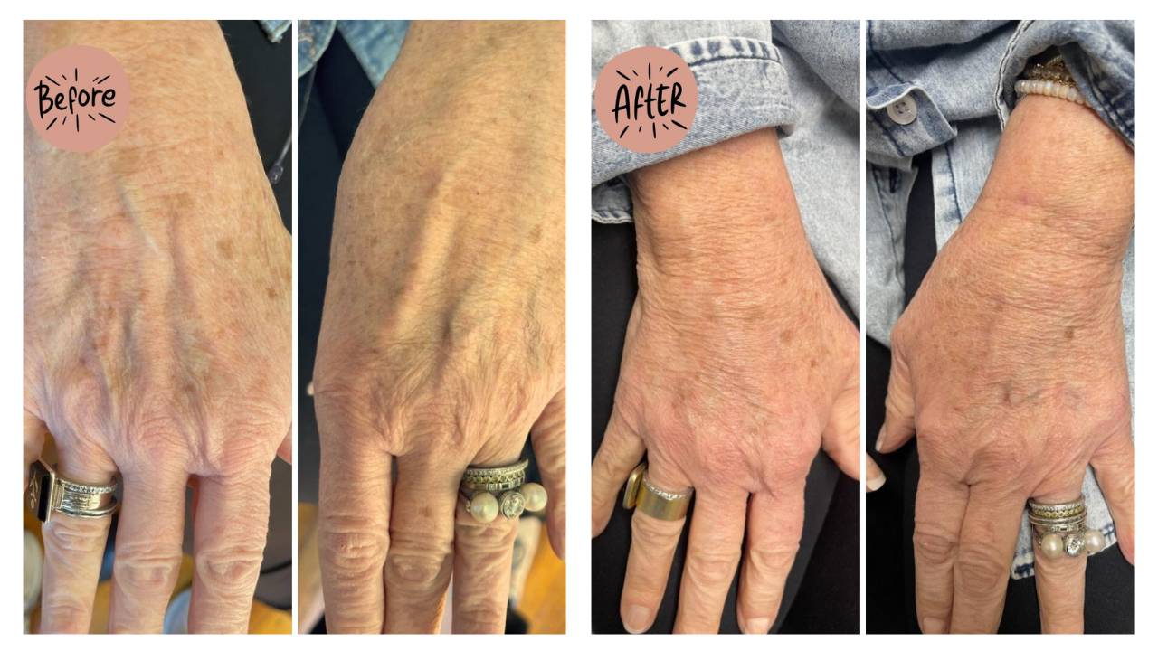 Radiesse for Hands
