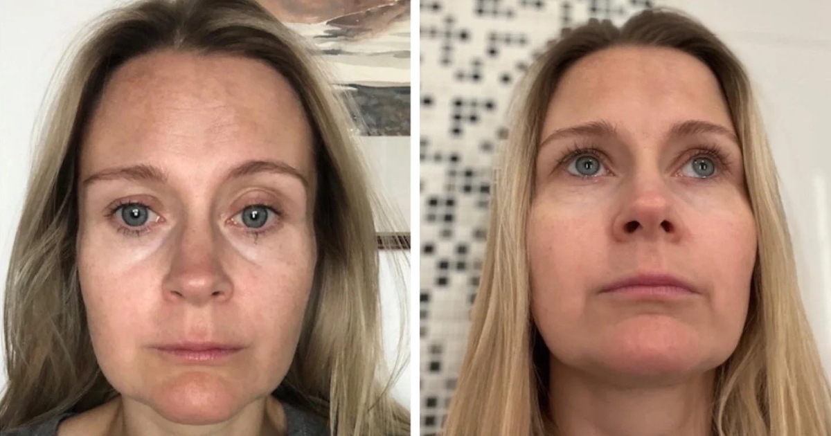 Klient med Ulcerös Kolit