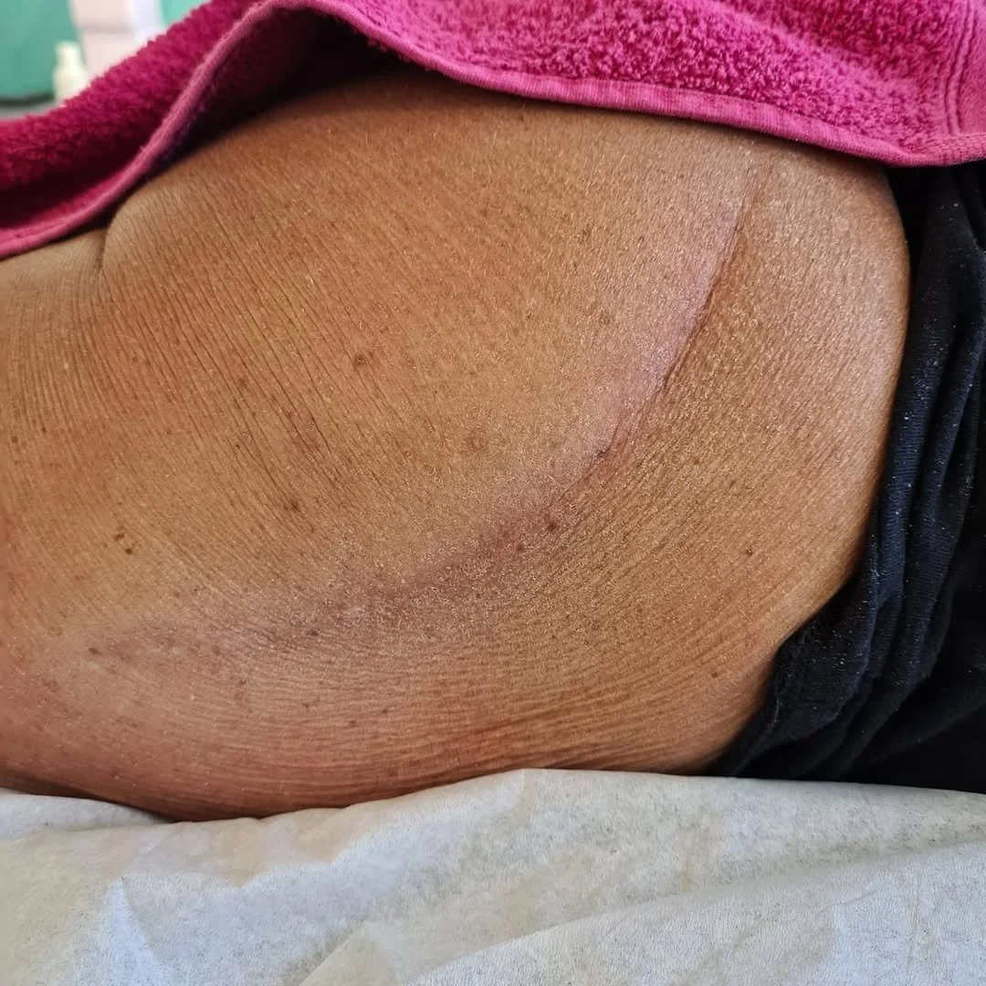 Before Scar Tissue Release Therapy