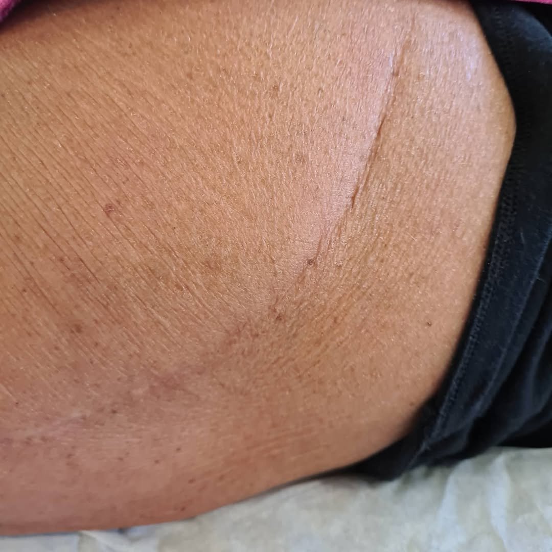 After Scar Tissue Release Therapy