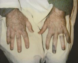 effects : wounds 9 copy.jpeg