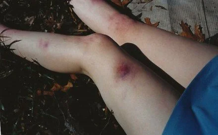 effects : wounds.jpeg