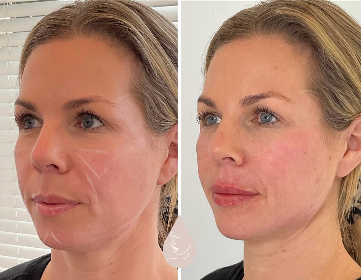 Subtle facial balance 💉 ✨
Before &amp; immediate after

The markings are intentional.
They show the exact areas treated to shift light balance and soften shadows.

Strategic placement = smoother transitions, better contour, and a fresher overall app