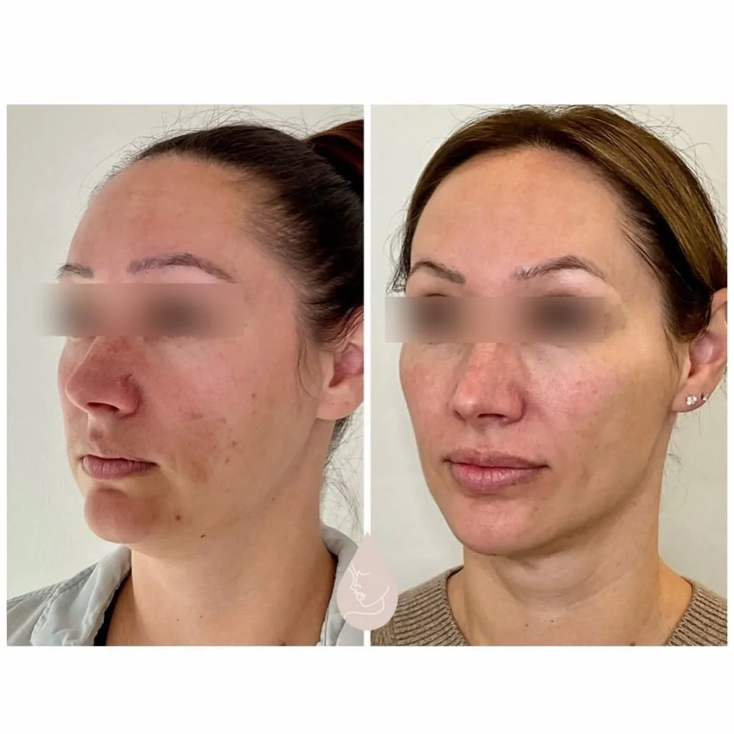 Full face 💉✨

4 years apart

Investing in yourself doesn&rsquo;t change who you are &mdash;
it helps you feel like yourself again.

Areas treated 
✨mid face 
✨chin
✨pre jowl &amp; lateral jaw
✨chin shadow
✨lips 
✨submental area (fat dissolve)

Sculp