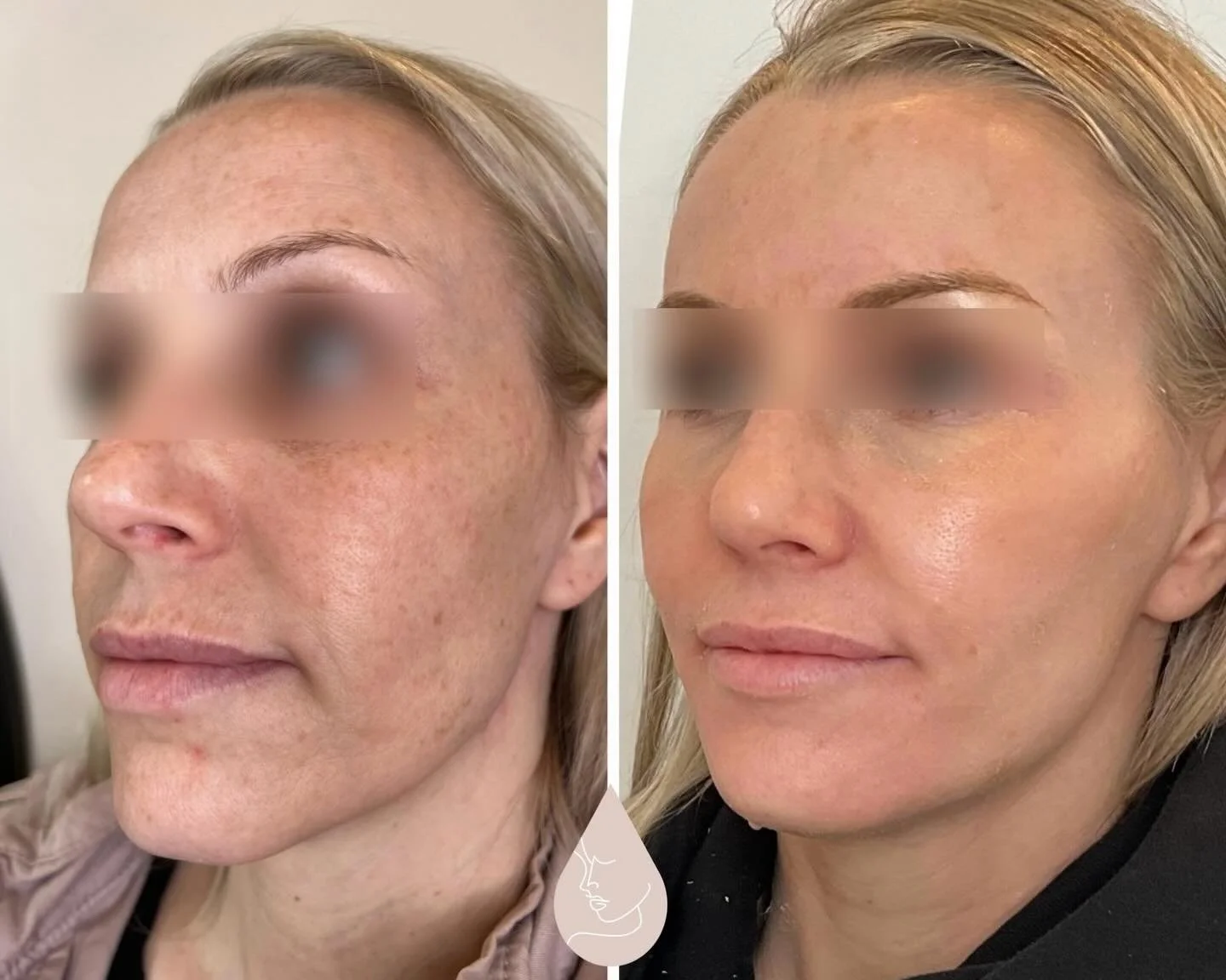 This is what happens when you treat structure and skin together.

✨ Filler to restore support.
✨ Sculptra to stimulate collagen over time.
✨ Dysport for lift, glow and wrinkle prevention. 
✨ Microneedling with PRP/PRF and medical-grade skincare to im