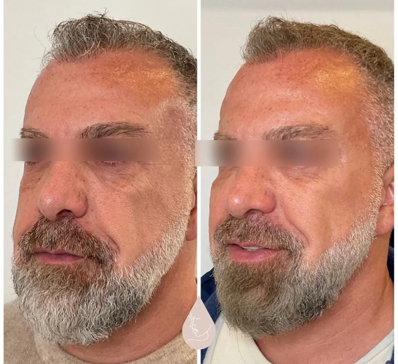 Structure restored with 𝐑𝐚𝐝𝐢𝐞𝐬𝐬𝐞

Masculine aging shows up in the way structure and fat pads descend, flattening the cheek and pulling light downward through the midface. This is what deepens the smile lines and creates a heavier lower face.
