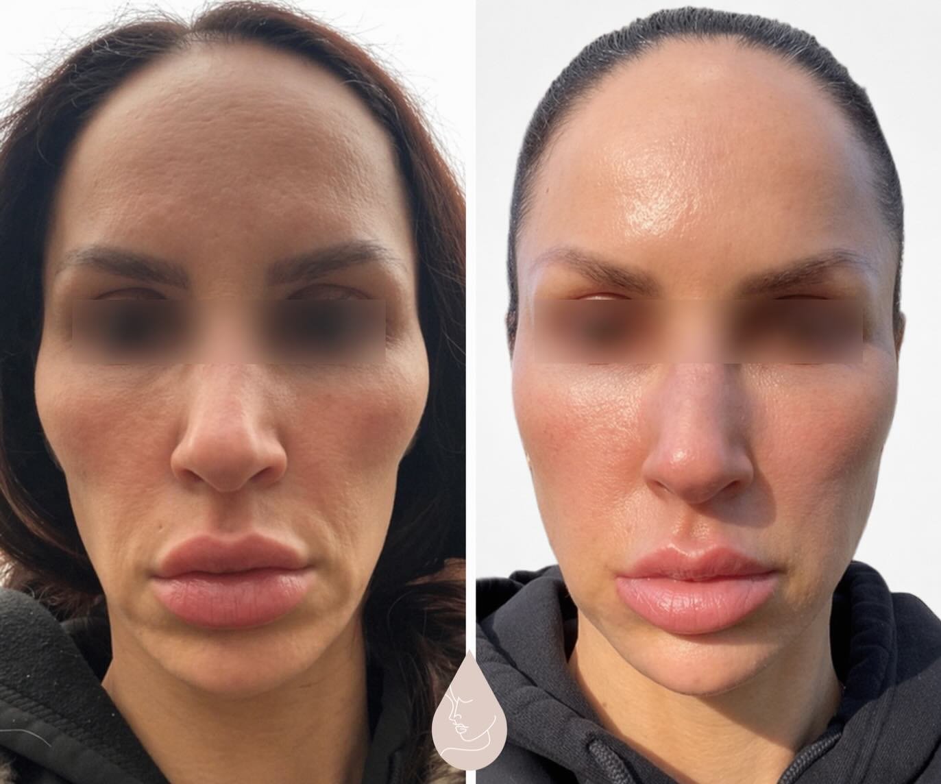 Restoring balance starts with treating the full face ✨

This transformation wasn&rsquo;t about adding more it was about refining. Strategic dissolving where needed, subtle filler placement, and primarily biostimulation with Radiesse and Sculptra to r