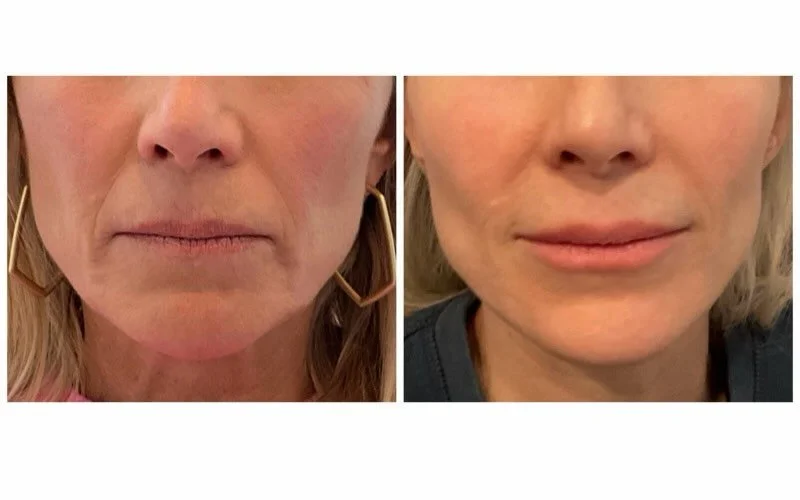 Lower face rejuvenation 💉 ✨

Aging of the lower face presents with loss of hydration to the lips, shadowing around the mouth, and the beginning of jowls. 

We restored structure through the lateral face with 𝗦𝗰𝘂𝗹𝗽𝘁𝗿𝗮, stimulating collagen wh