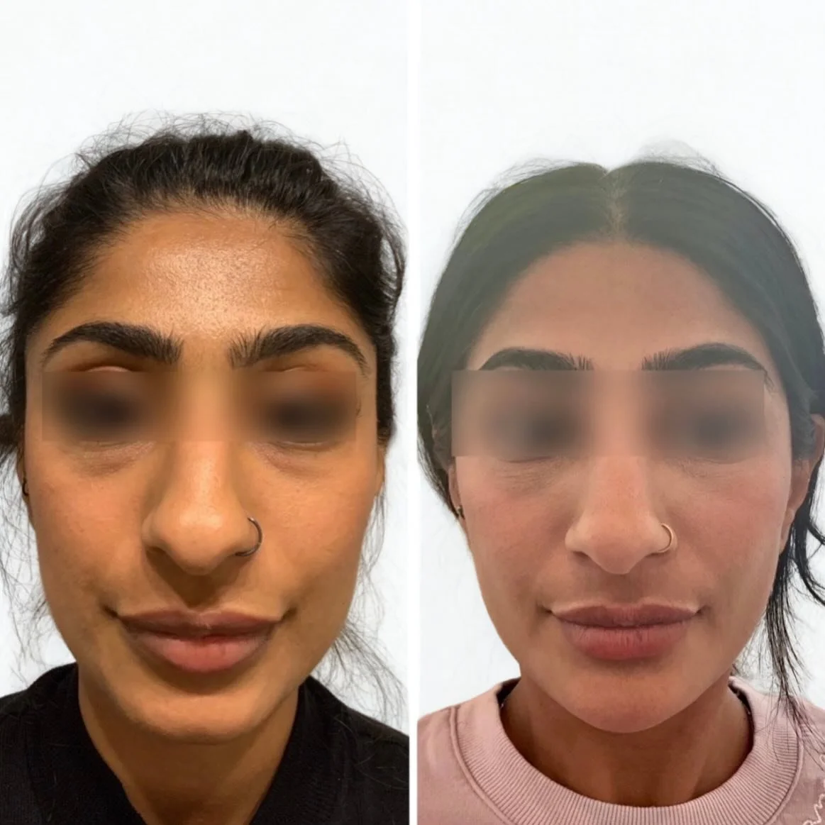 7 years together ✨

One of the biggest compliments is having patients trust us through the years as we evolve their treatment plan together.

We used a combination of gradual structural support through the cheeks/ under eyes, chin, jawline, and skin 