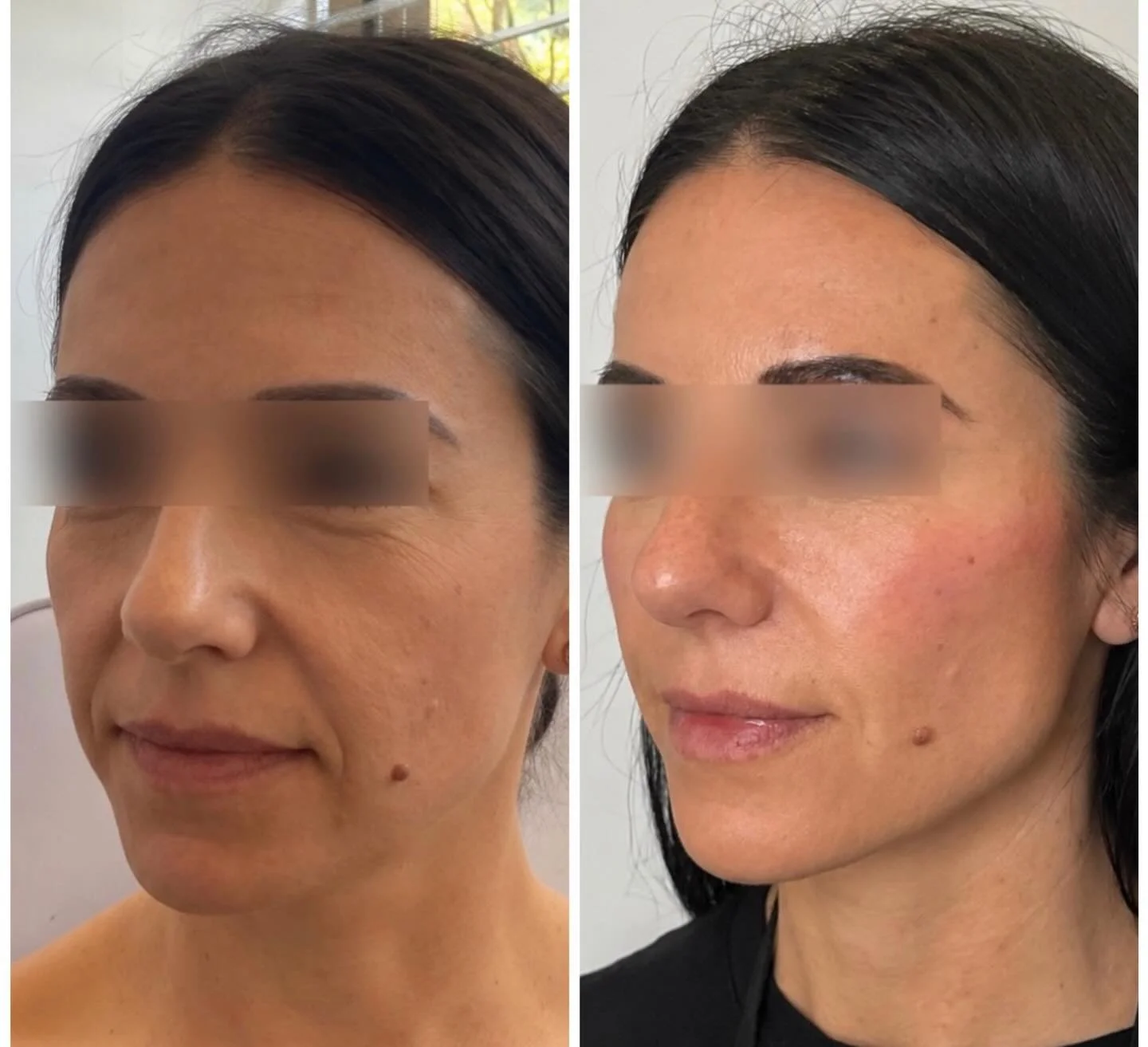 Facial balancing over 3 years 💉 ✨

A combination of strategic dermal filler and Sculptra was used to restore facial support, improve balance, and stimulate collagen production.

Areas treated:
&bull; Temples
&bull; Midface/cheeks
&bull; Nasolabial f
