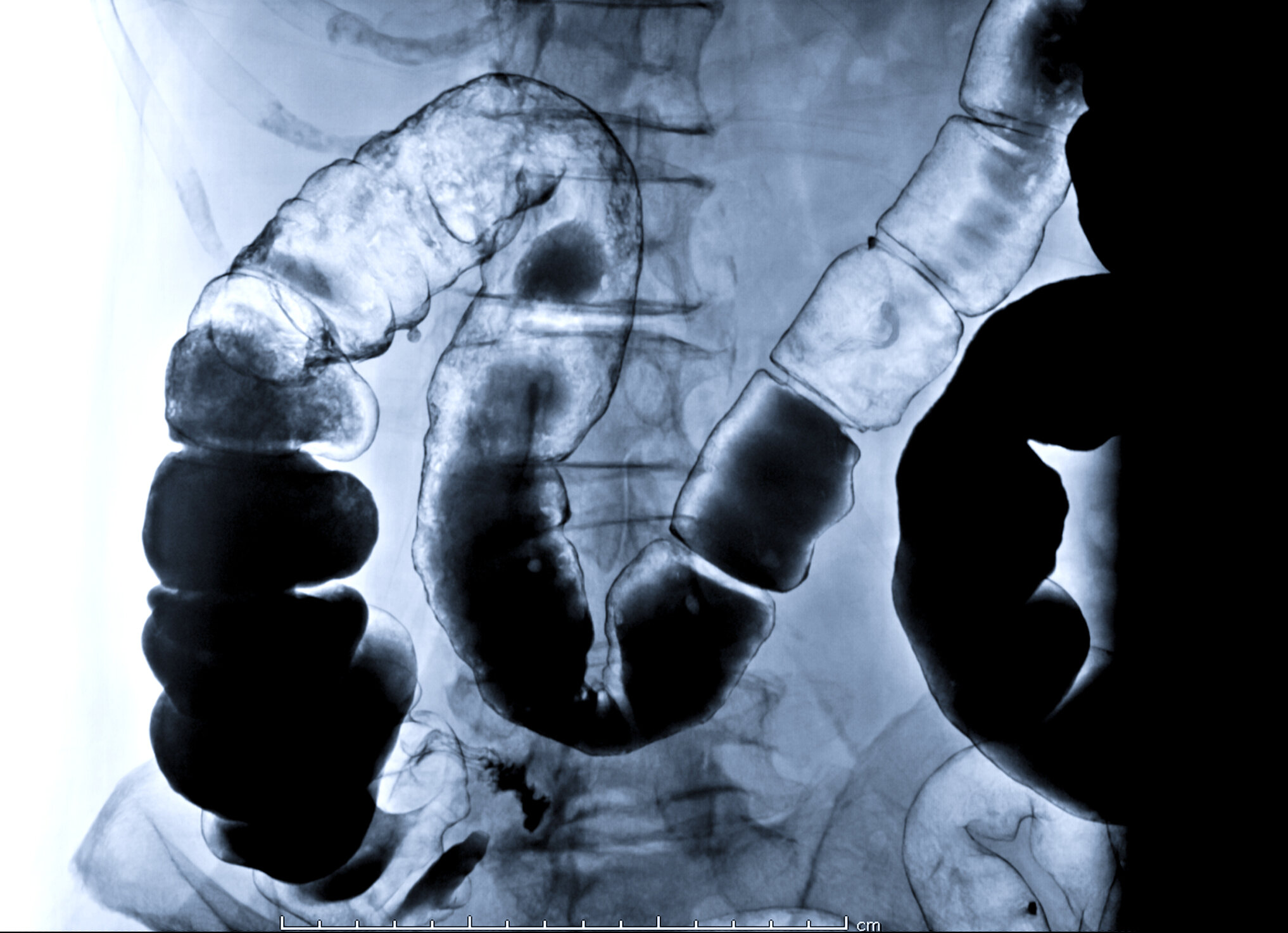 Fluoroscopy