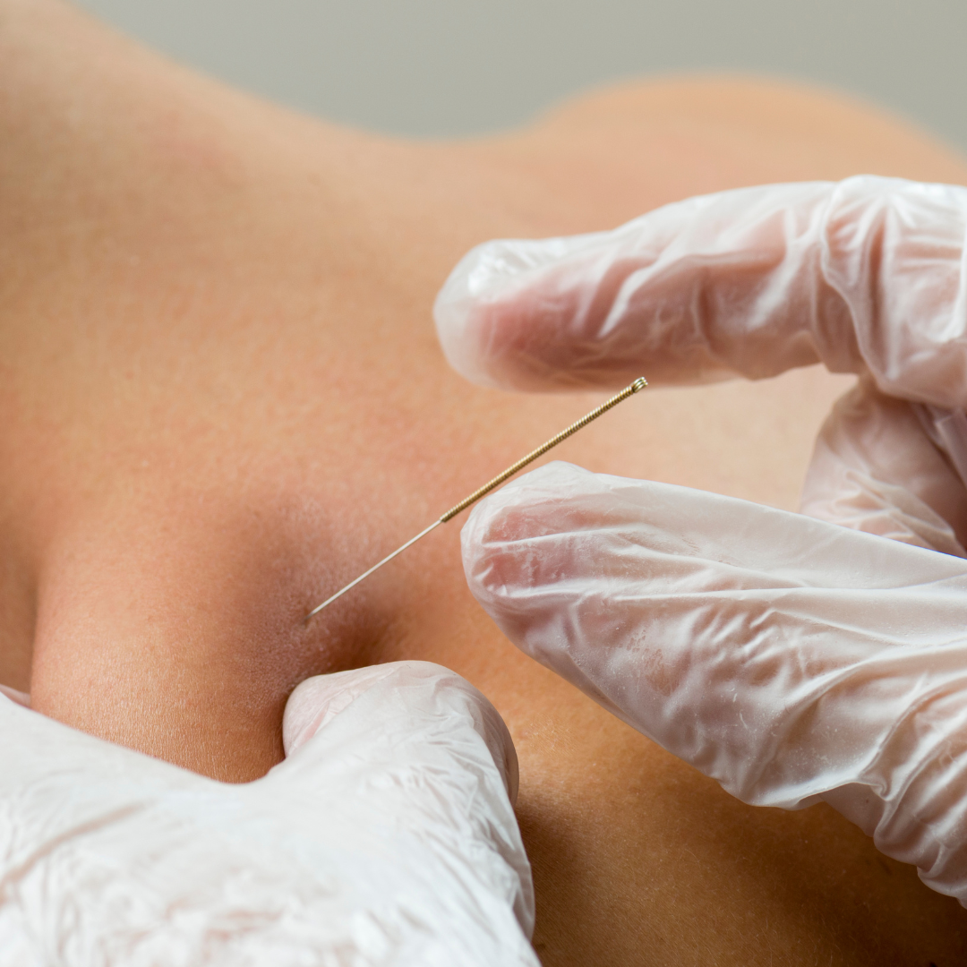 Dry Needling & it's Benefits — Women In Motion Physical Therapy & Wellness
