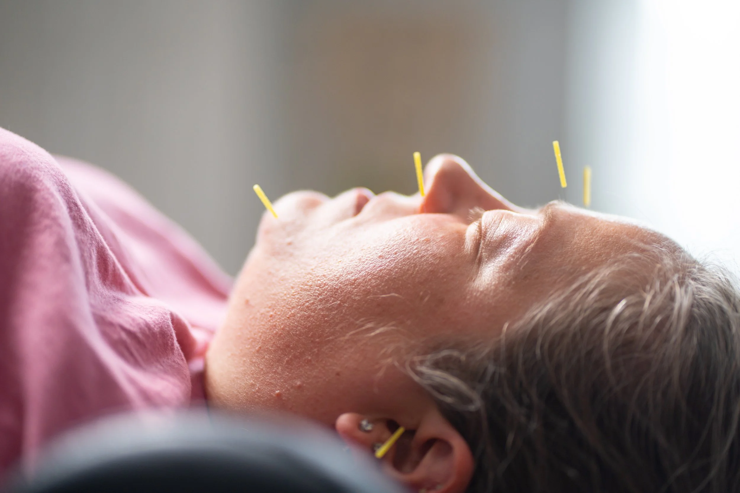 Unveiling the Needle's Magic: Dry Needling for Headaches and Migraines