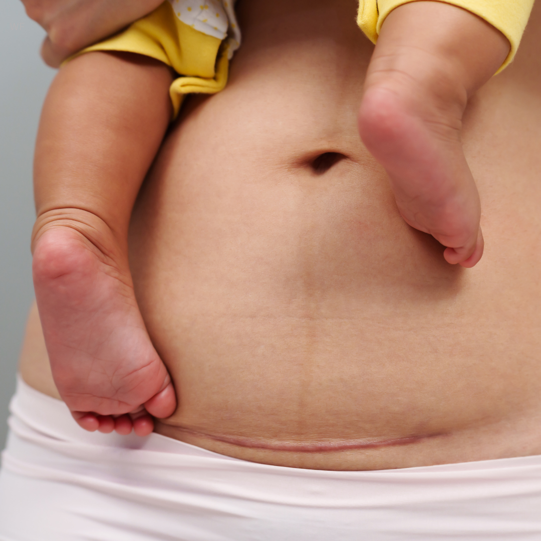 C-Section Recovery: How Physical Therapy Helps You Heal Stronger