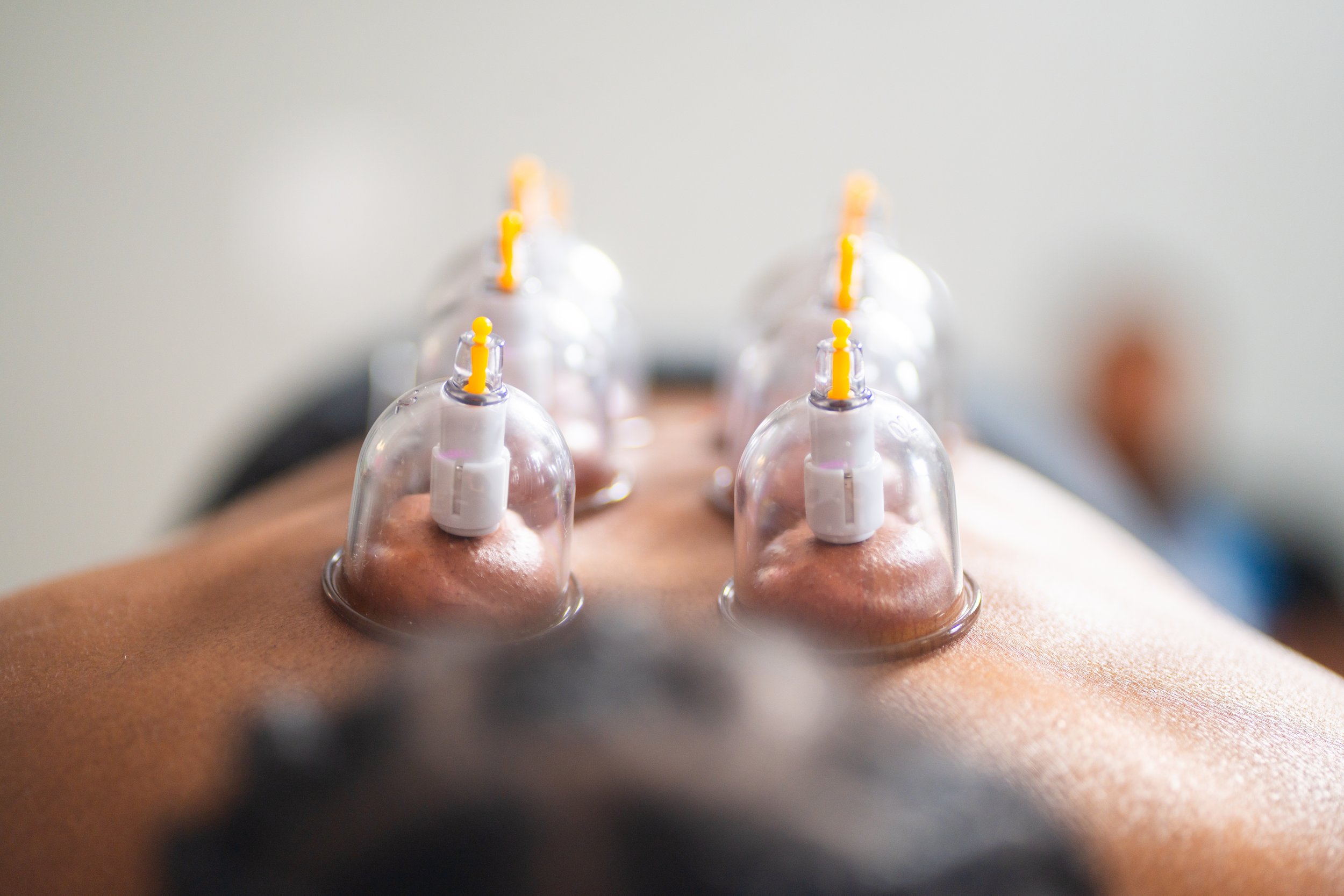 How Do Physical Therapists Use Cupping?