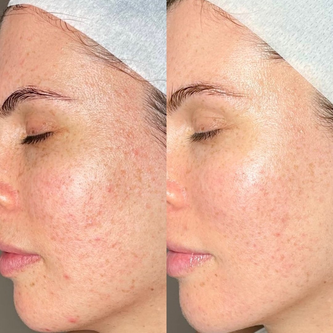 Let us take the stress out of ensuring healthy, glowy skin on your wedding day 💍​​​​​​​​
​​​​​​​​
Glo&rsquo;s Skin Therapist Sarah tailored an in-clinic regime of 3 x PRP, 2 x LED and 1 x Glo Tox Facial, to combat our clients&rsquo; stubborn breakou