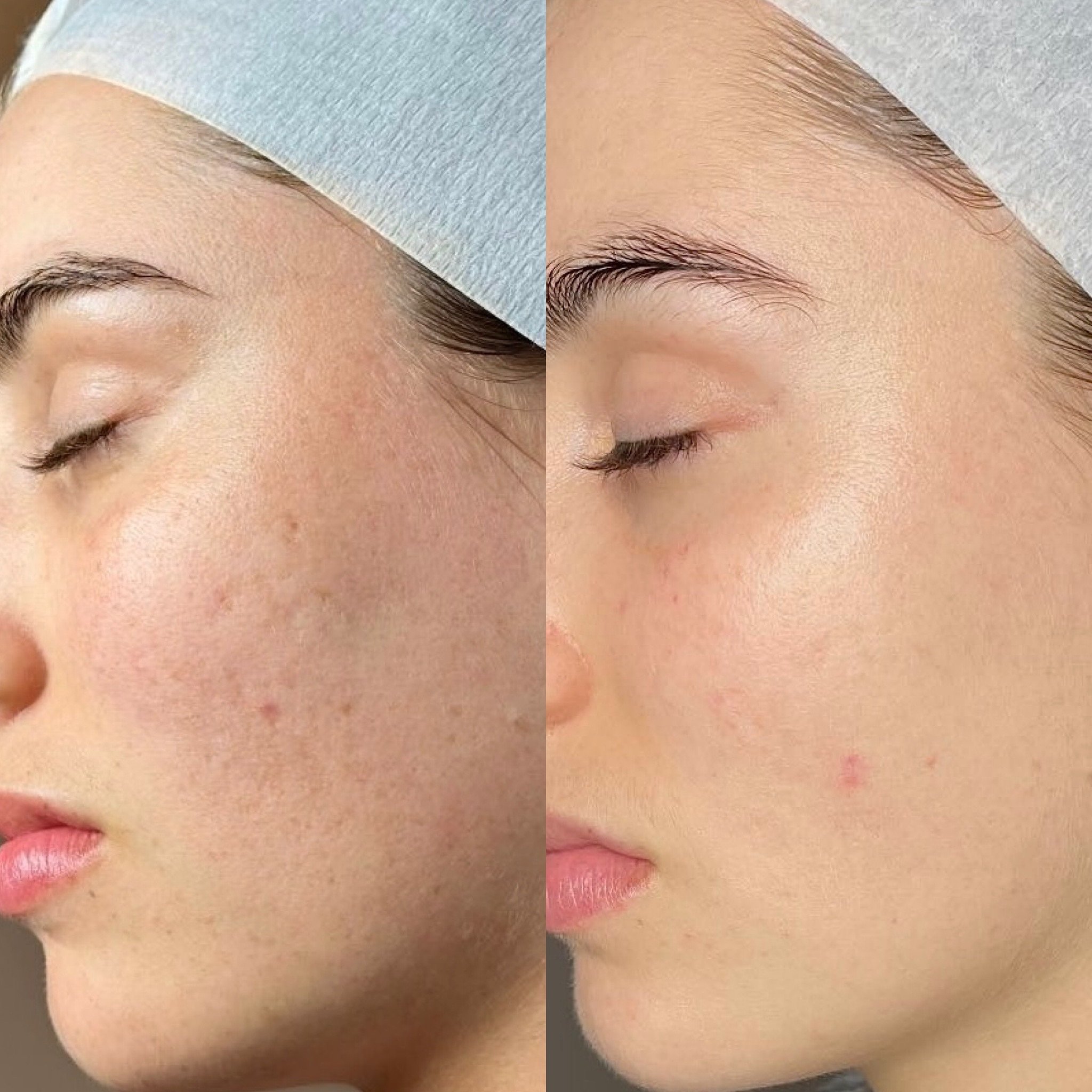 It starts with a consultation and ends with these results. Our signature PRP Facial is a Glo gals favourite treatment.