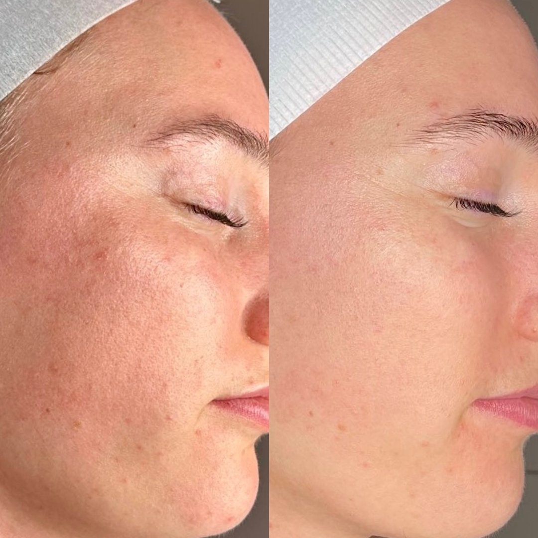 Our bride guide to achieving bright and clear skin for our lovely Glo gal consisted of 3 x PRP, 2 x Lactic Peels and 1 x LED Facial.

This was paired with at home heroes &lsquo;Surge&rsquo; and EFA&rsquo;s.