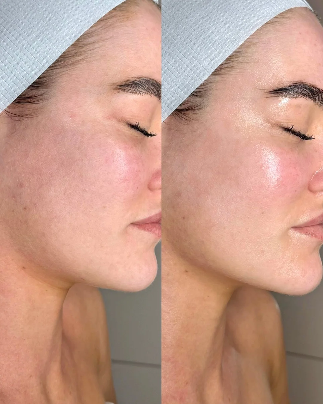 Give your skin the ultimate treatment it deserves with our newest addition to the Glo menu. ​​​​​​​​
​​​​​​​​
The UltraBoost Facial utilises our Ultraformer MPT hand piece alongside a potent cocktail of skin-boosting actives to replenish collagen and
