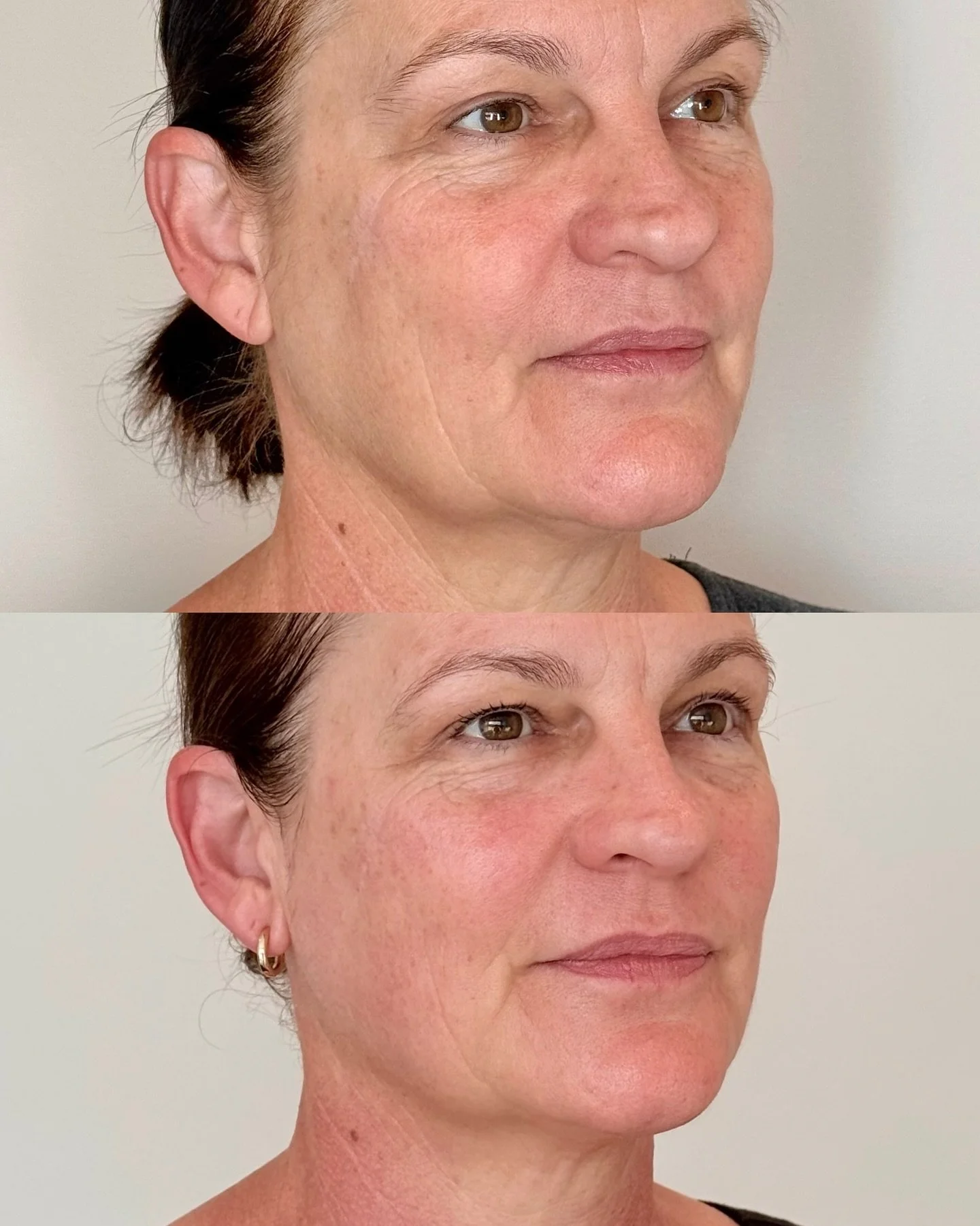 Hands up if you love HIFU! Our Glo mumma certainly does &mdash; it&rsquo;s her go-to treatment for a lifted, youthful look.

Our Ultraformer MPT is the latest advancement in HIFU technology, designed to lift, tighten, and contour the face and neck. T