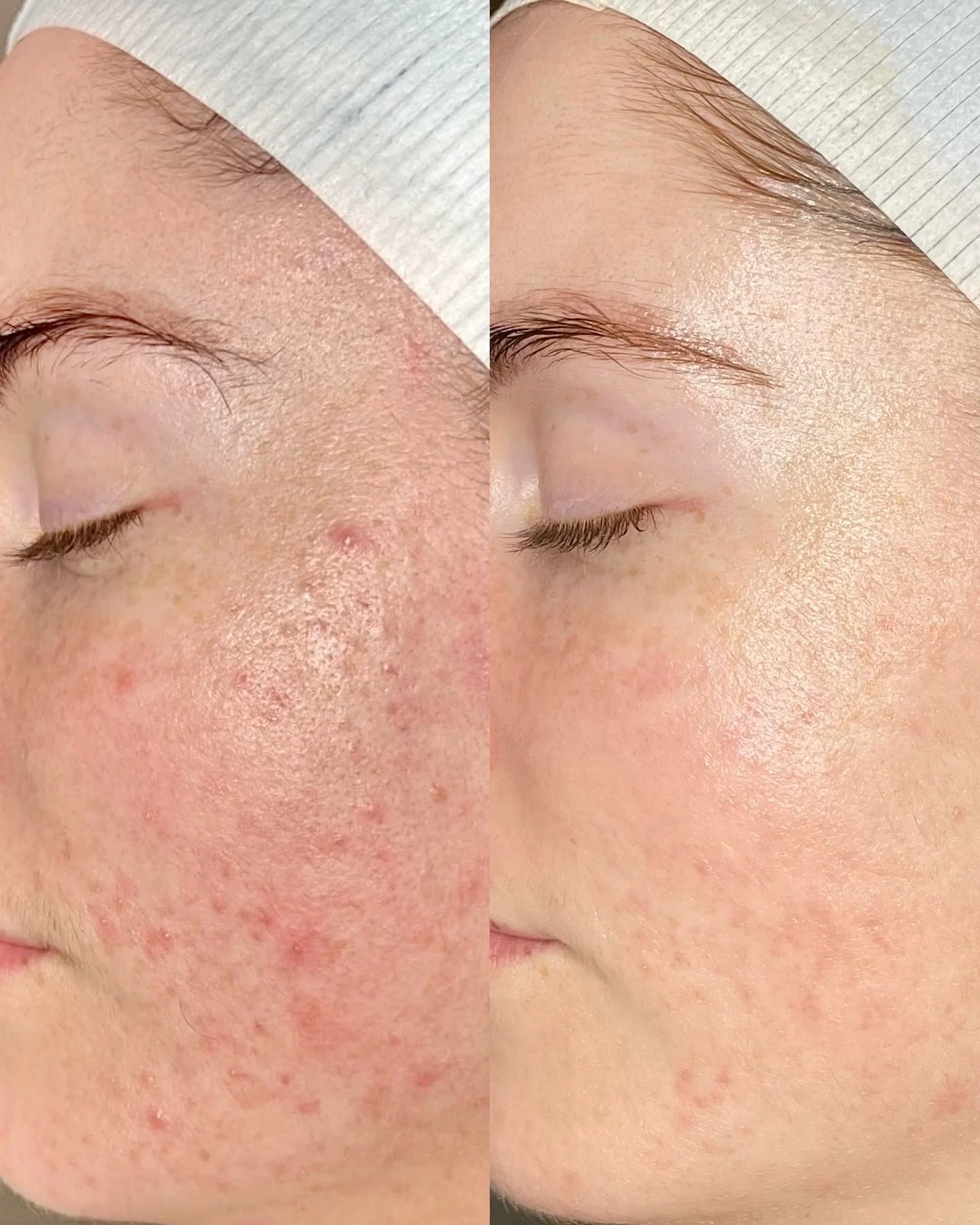 Combatting our Glo gals breakouts and congestion with 3 x LED facials and an ample array of our Signature Power Peels, resulting in a rejuvenated complexion.
⠀⠀⠀⠀⠀⠀⠀⠀⠀
⠀⠀⠀⠀⠀⠀⠀⠀⠀
Book online or in clinic.