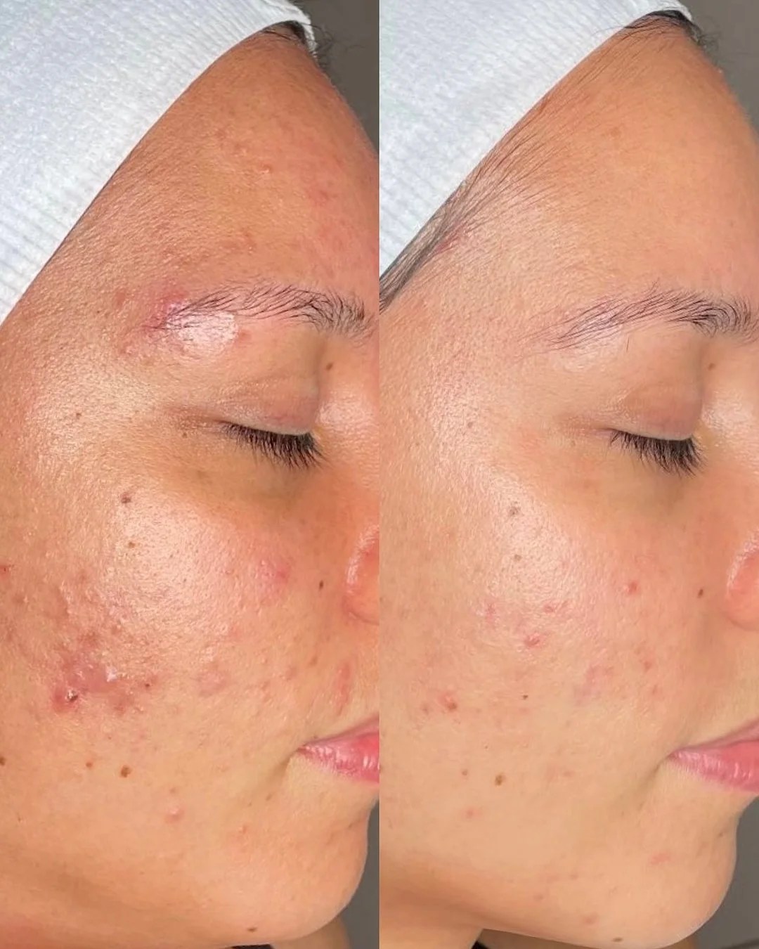 To combat congestion and calm the complexion, we created a targeted treatment plan for our Glo gal. With advanced peels, skin needling, and our hero homecare heroes &mdash; Retinol Concentrate and B3+ &mdash; our bride-to-be is well on her way to wed