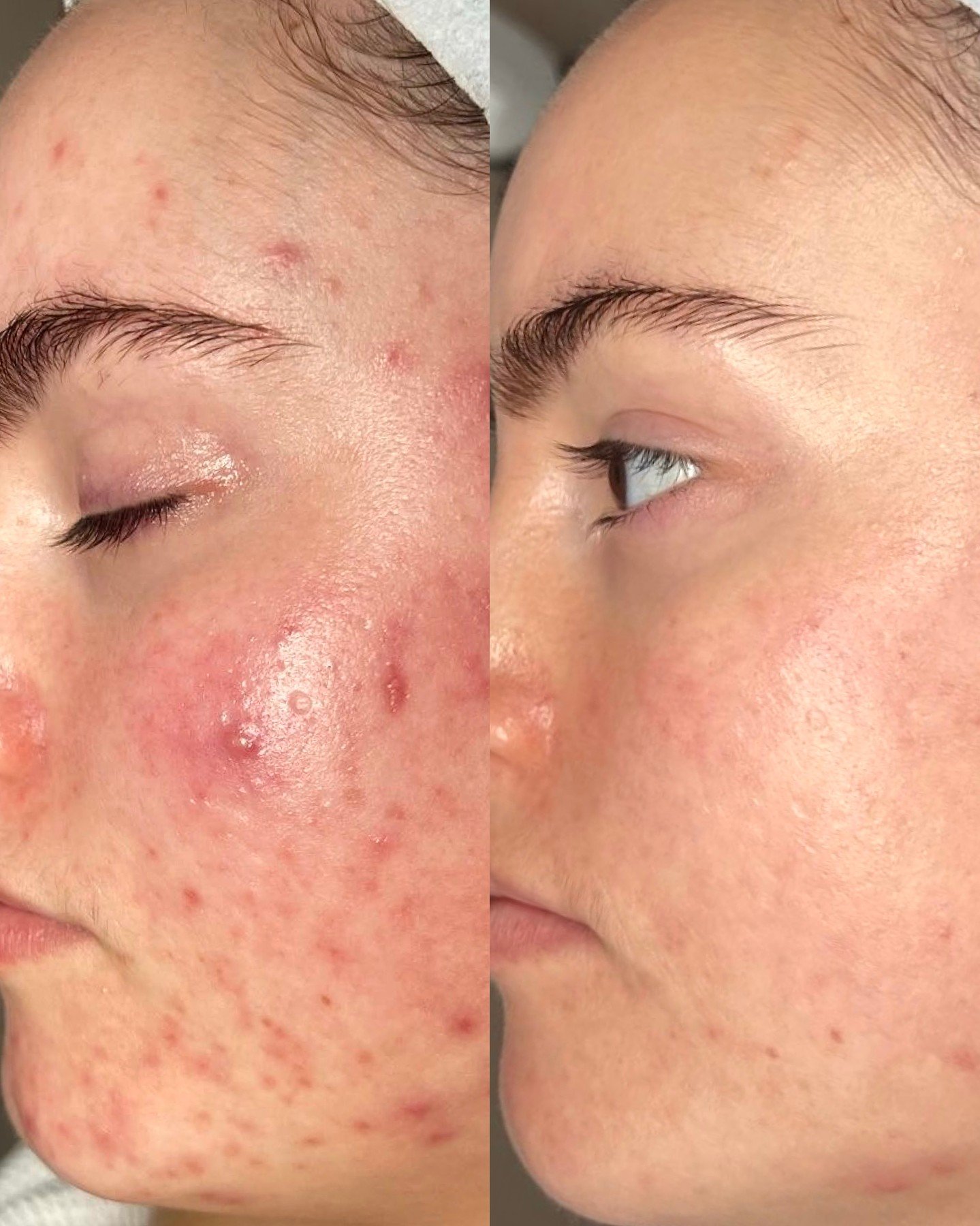 18 months with our Glo gal proving that consistency is the cornerstone of healthy skin. ��With an in-clinic combination of LED, Peels and PRP, paired with a calm and considered at-home routine, we&rsquo;be been able to achieve a healthy complexion. 
