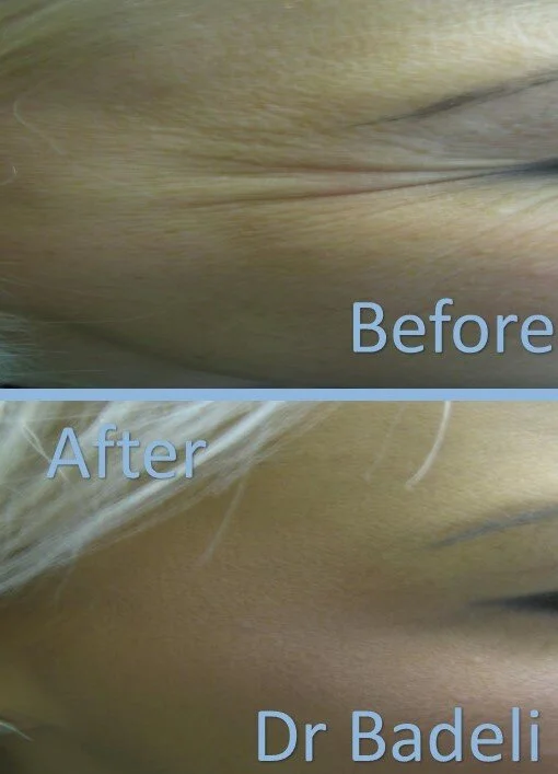 Botox frown line chester dentist.jpg
