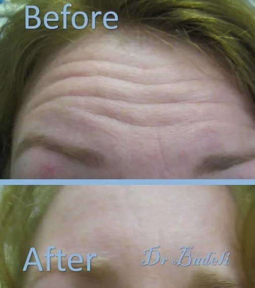 Botox facial upper 02.jpg