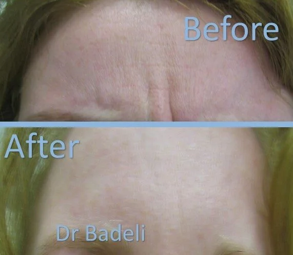 Botox facial upper 01.jpg