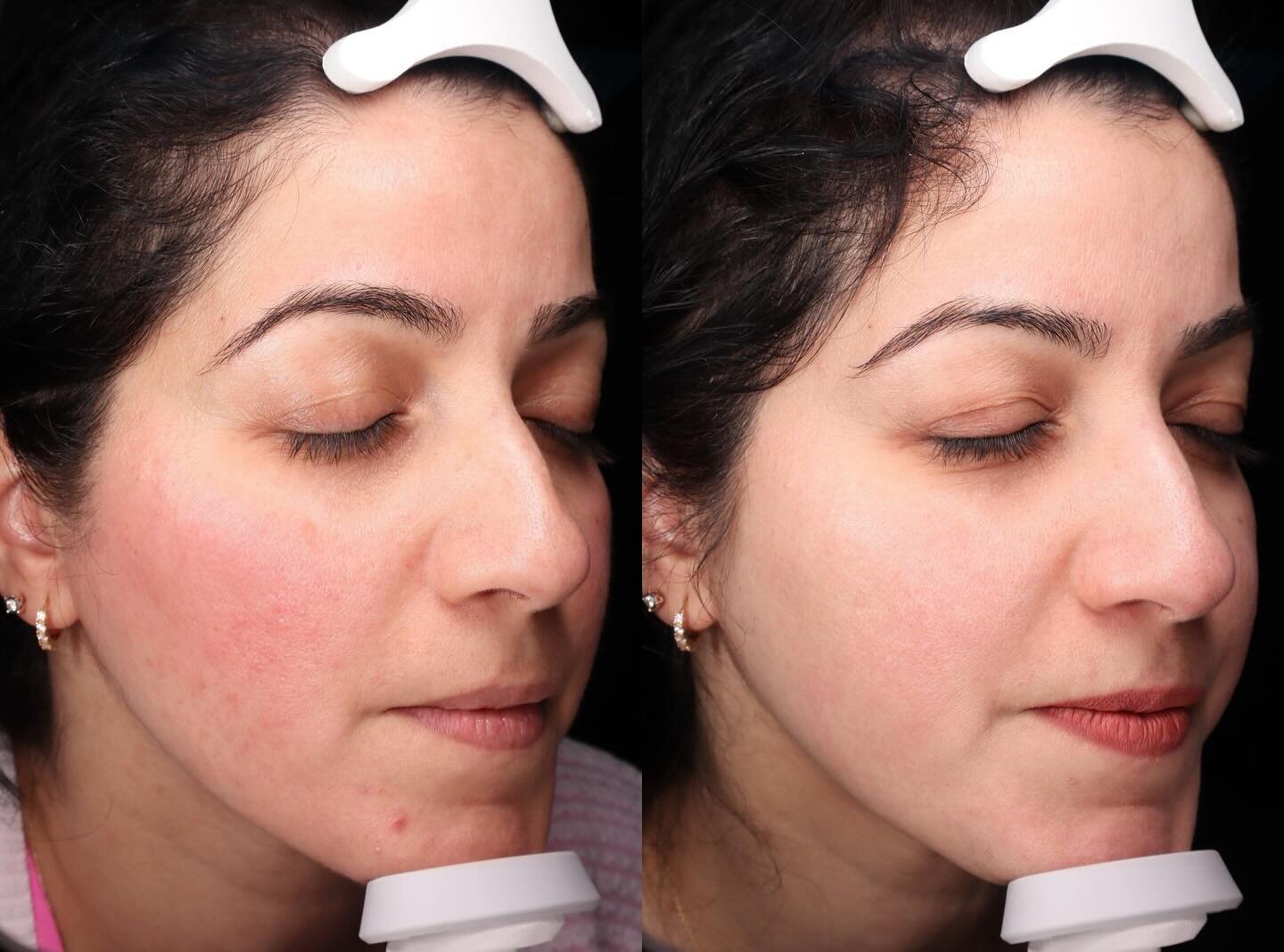 Learning how to properly manage your Rosacea can be LIFE changing! There are many options when it comes to managing this skin condition, it can be overwhelming at times. Don&rsquo;t fret, that&rsquo;s what I&rsquo;m here for! 😜

This client came in 