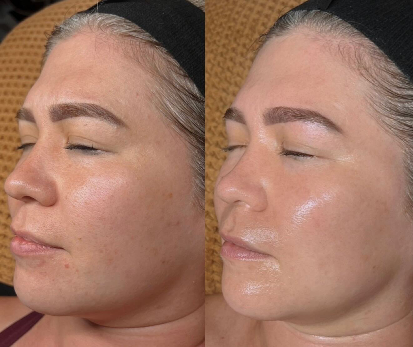 The SkinPen&reg; difference is truly remarkable!

This client completed a series of four SkinPen&reg; microneedling treatments, enhanced with @zoskinhealth Accelerated Serum to target pigmentation, improve skin laxity, and minimize pore size. To furt