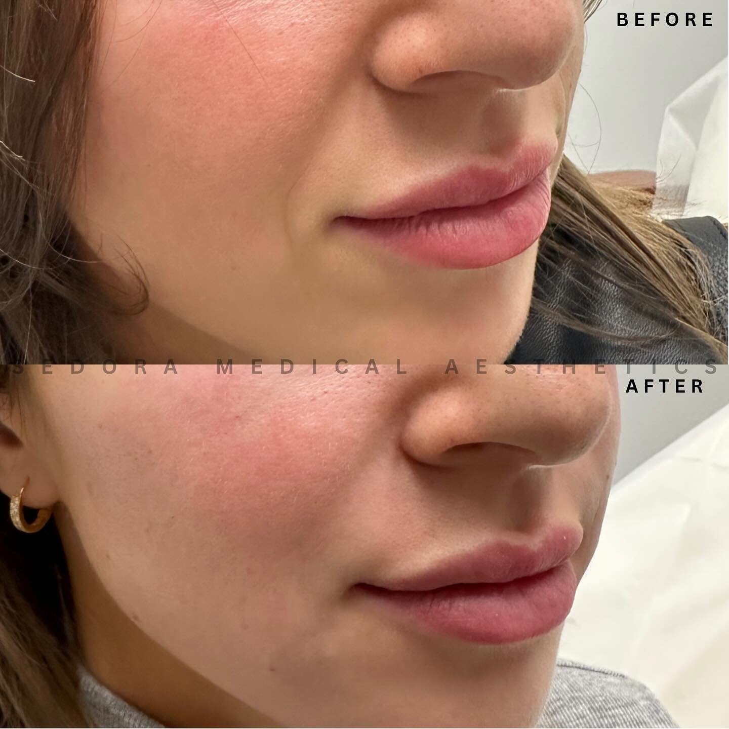 Smile Line Filler 💉Airbrushing away those deep folds beside the mouth.

Obsessed with how seamless filler looks in this area. Designed to help support your natural expressions - maintaining natural movement when you smile.

Book with us today! 
☎️(9