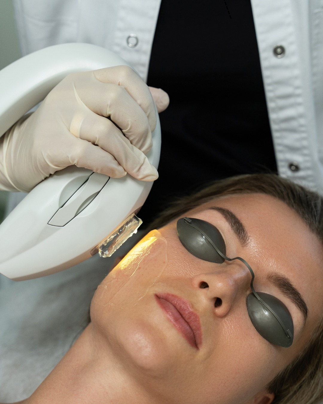 IPL- Photodermal Renewal Package
