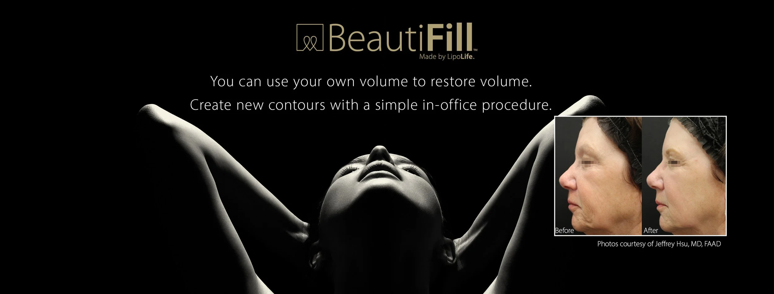 Laser Fat Transfer (Liposuction) of Westchester County — Sedora Spa