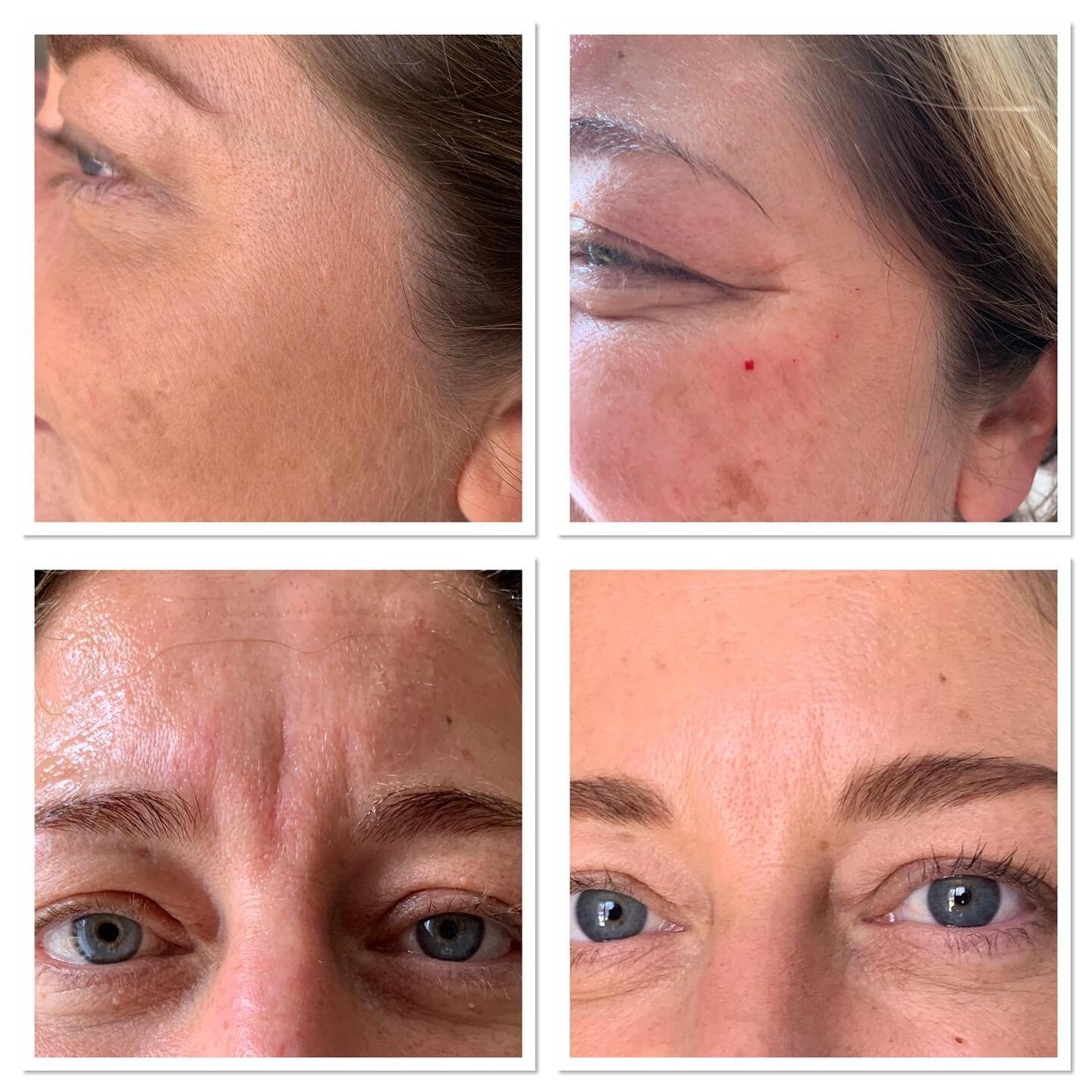 Some before and after photos of Anti-Wrinkle injections on three areas of the forehead and around the eyes.
.
.
#botox #antiwrinkle #frownlines #freshfaced #transformation