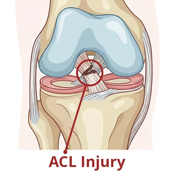 Illustration of an ACL injury in the knee joint with highlighted tear, showing damage to the anterior cruciate ligament.