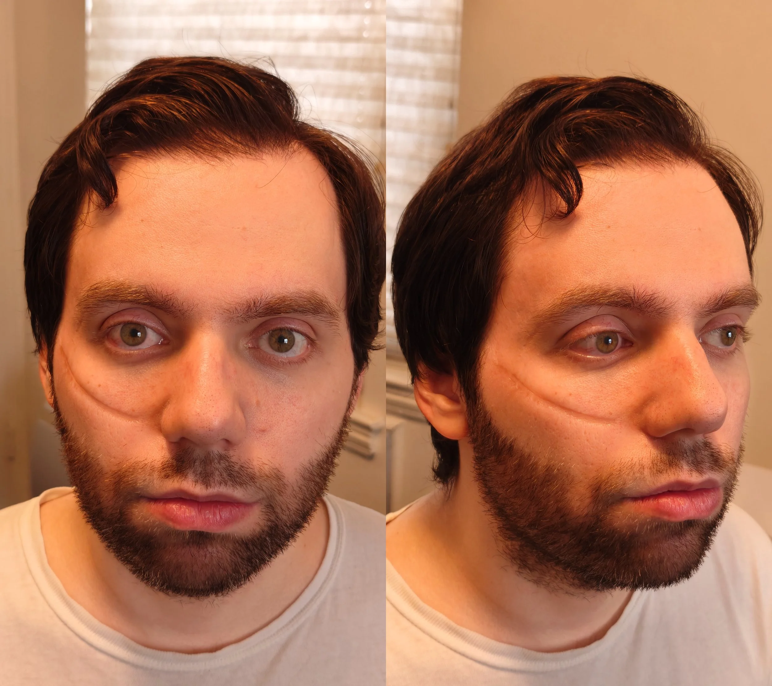 Rigid collodion atrophic scar; Process