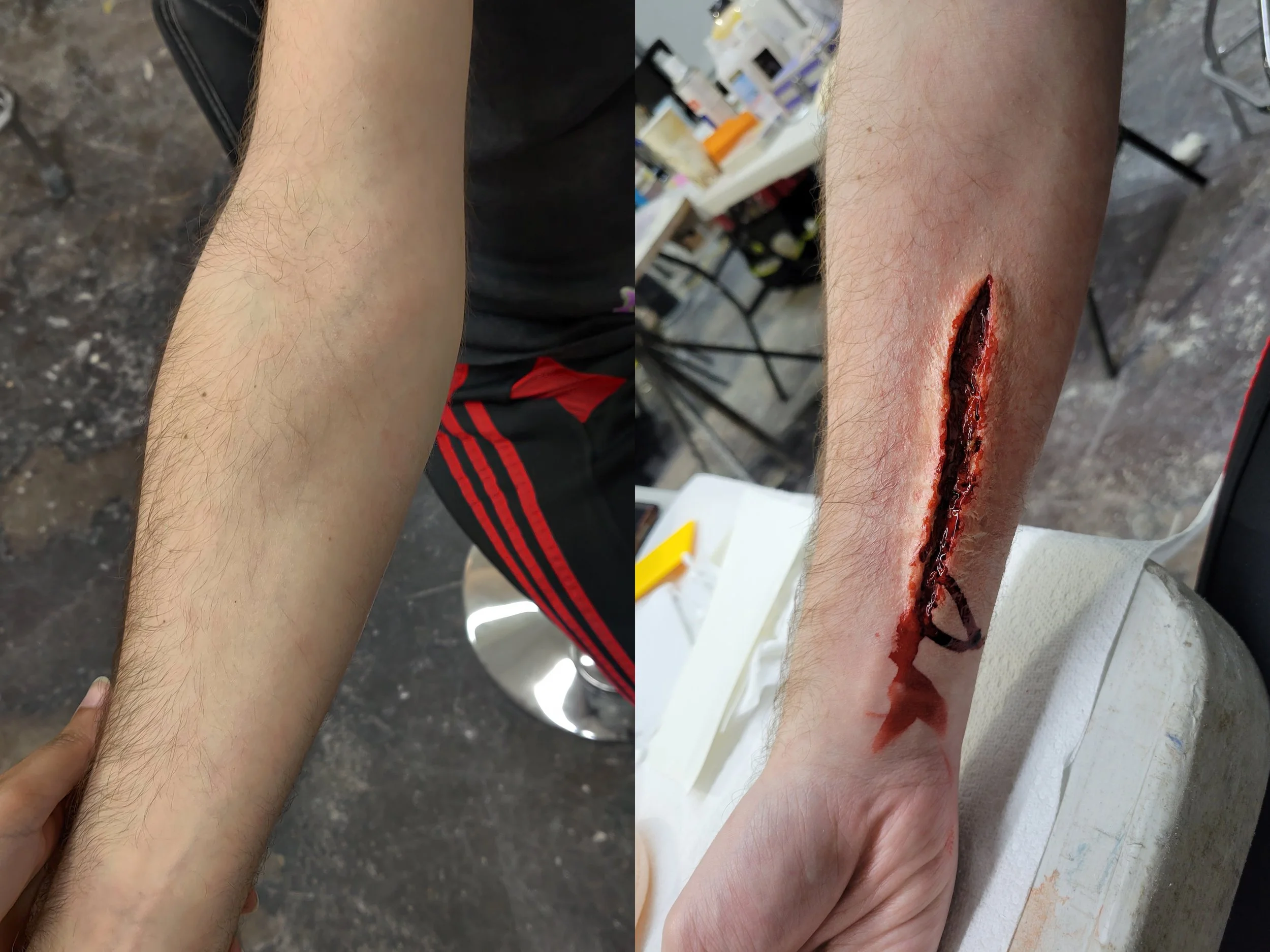Large laceration prosthetic transfer application; Before (left), After (right)