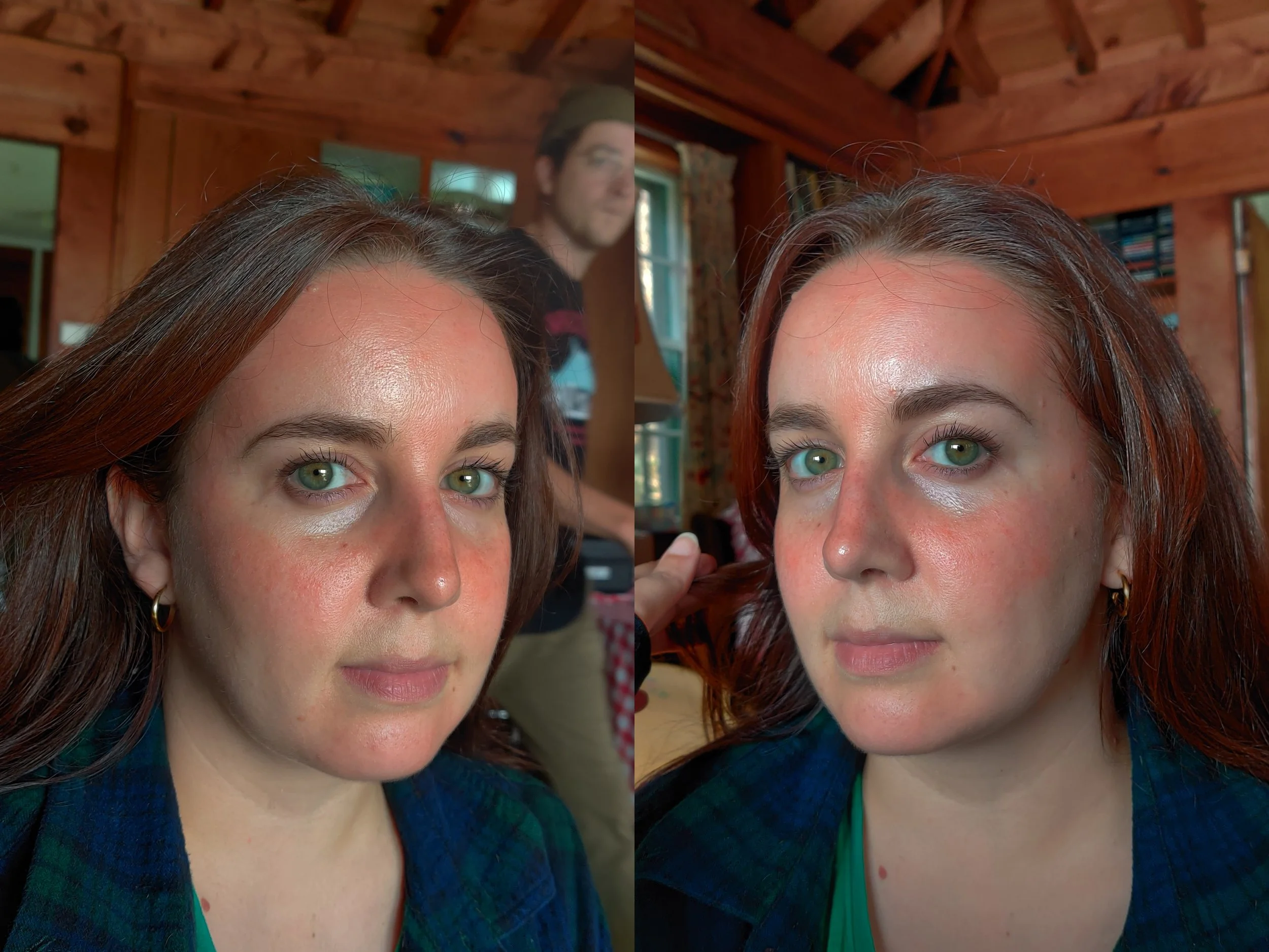 facial sunburn (side views)