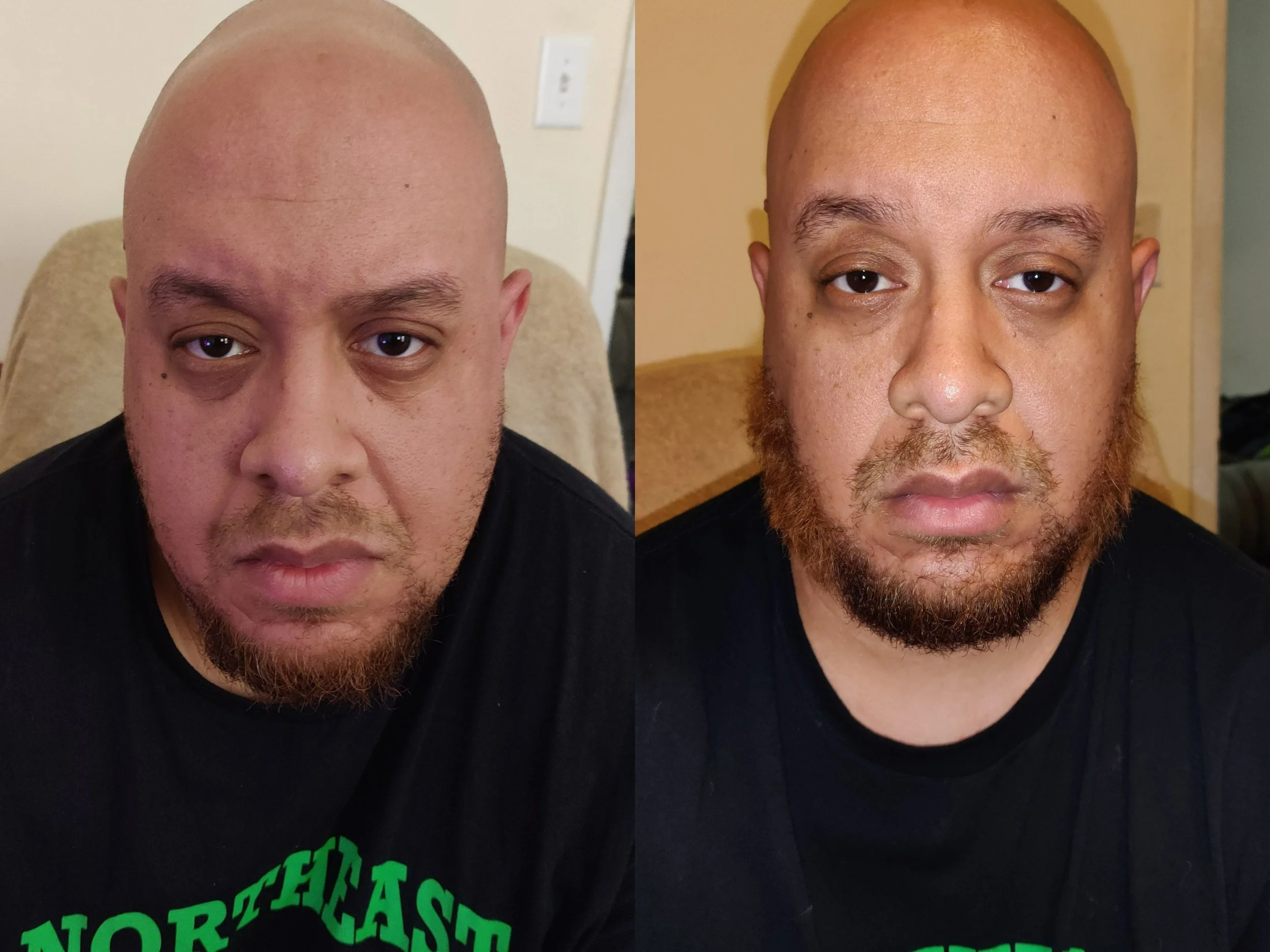 Hand laid beard application; Before (left), After (right). Wool color was matched to the tones in subject's mustache and auburn highlights in the beard to represent the natural look of the model when hair grows in on the cheeks. (Blondish auburn must