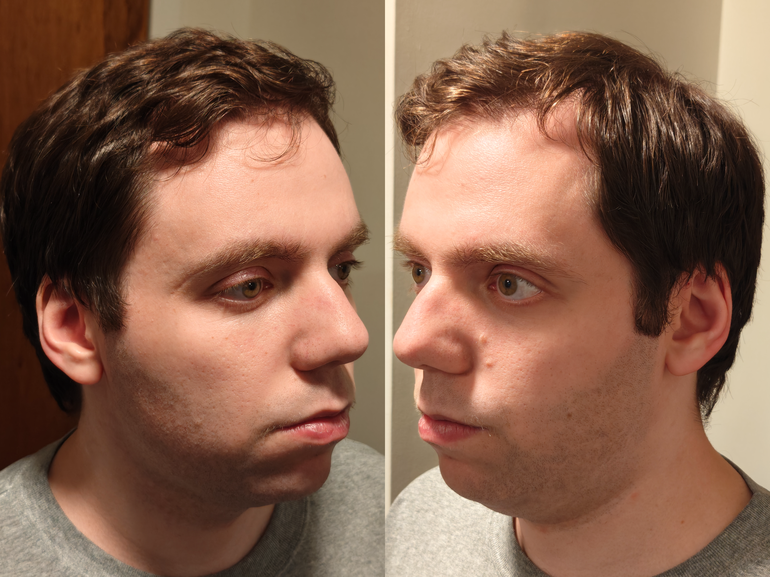 Before (sides)
