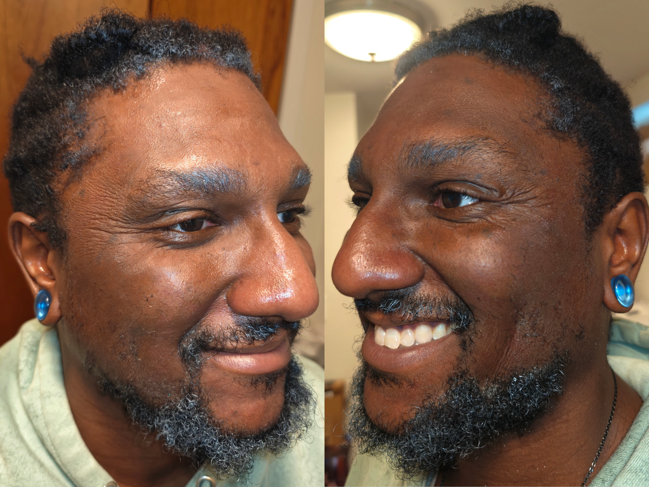 Aging (After; side angles)