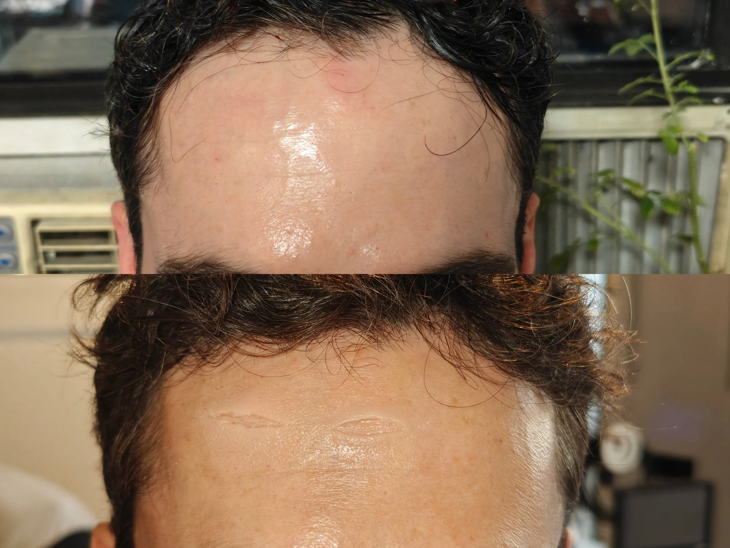 Prosthetic cuts application