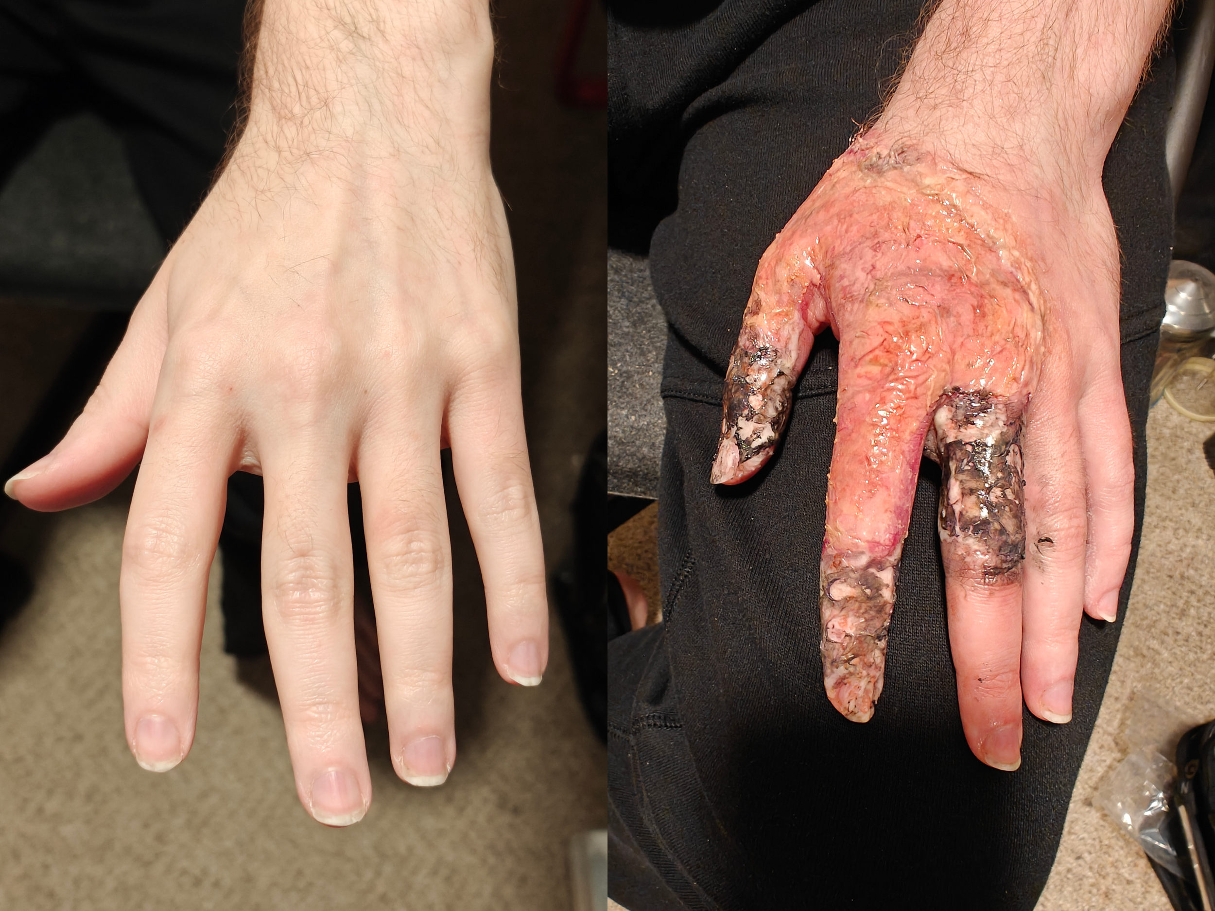 Chemical burn with some third degree charring on the fingers application using Third Degree Silicone Modeling Compound, cap plastic sheets, cream and alcohol colors; Before (left), After (right) 