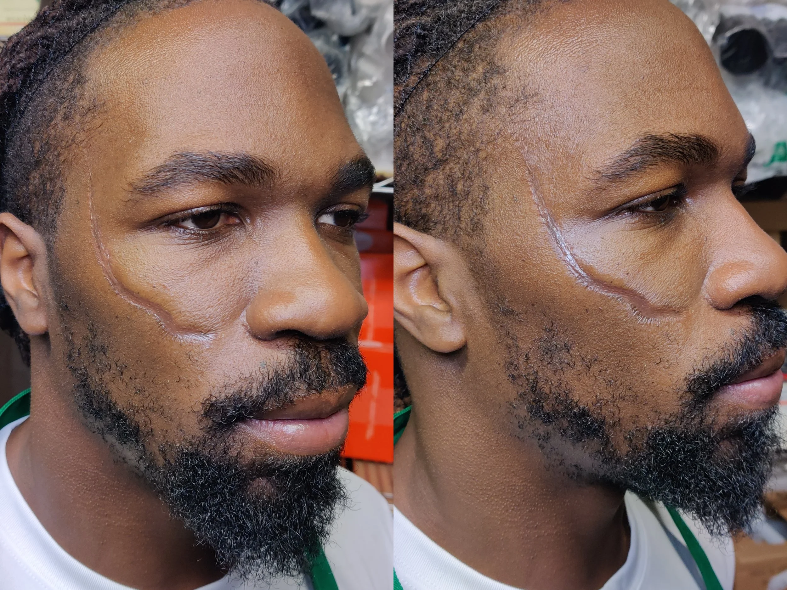 New York Jets linebacker CJ Mosley after atrophic scar application using rigid collodion, probondo stipple, and alcohol activated paints. Skin prepped with witch hazel, 70% IPA, and Kryolan Pro Shield Barrier Foam.