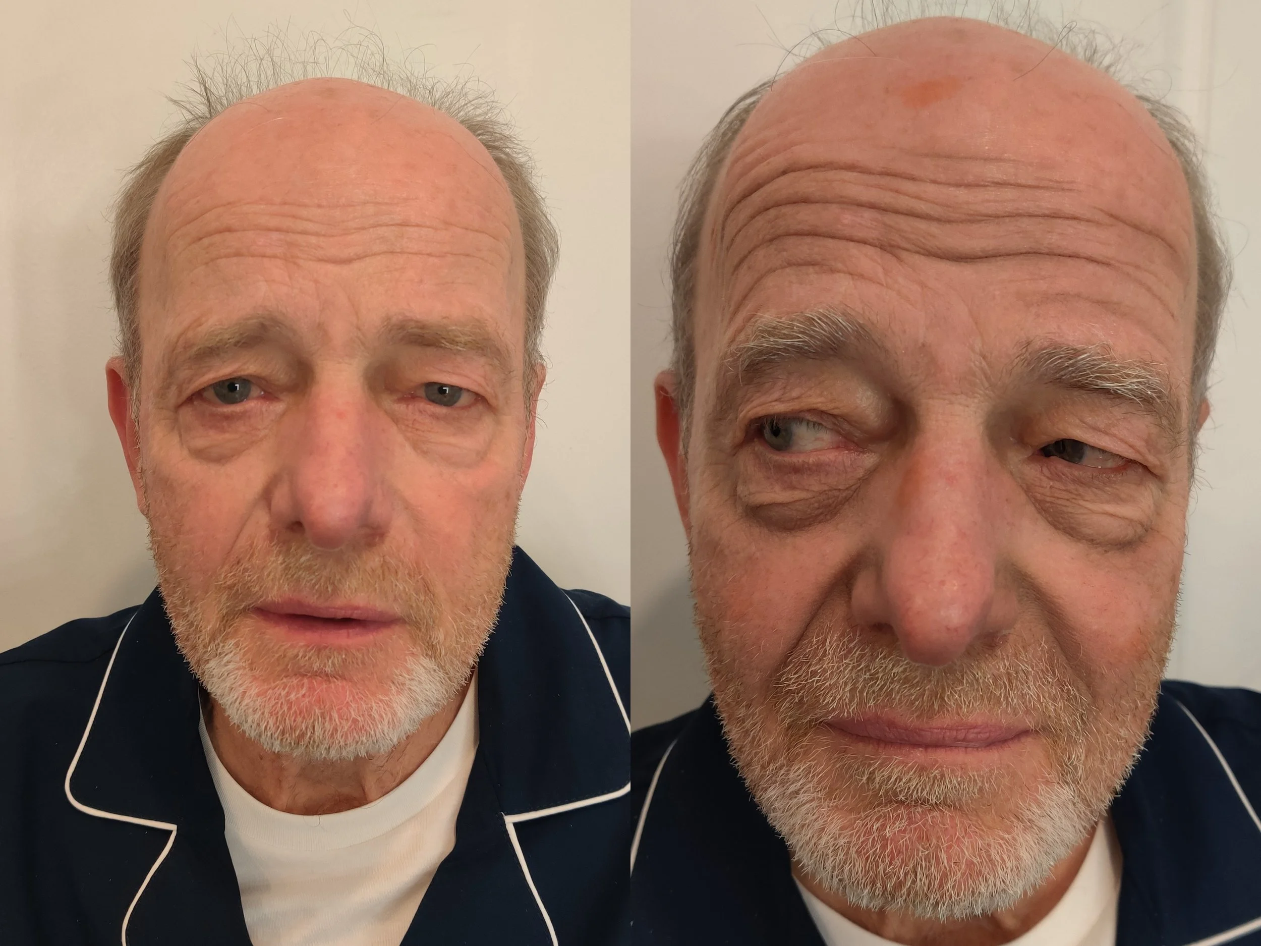 Subtle stage/highlight & shadow aging with application of some gray hair using alcohol colors.