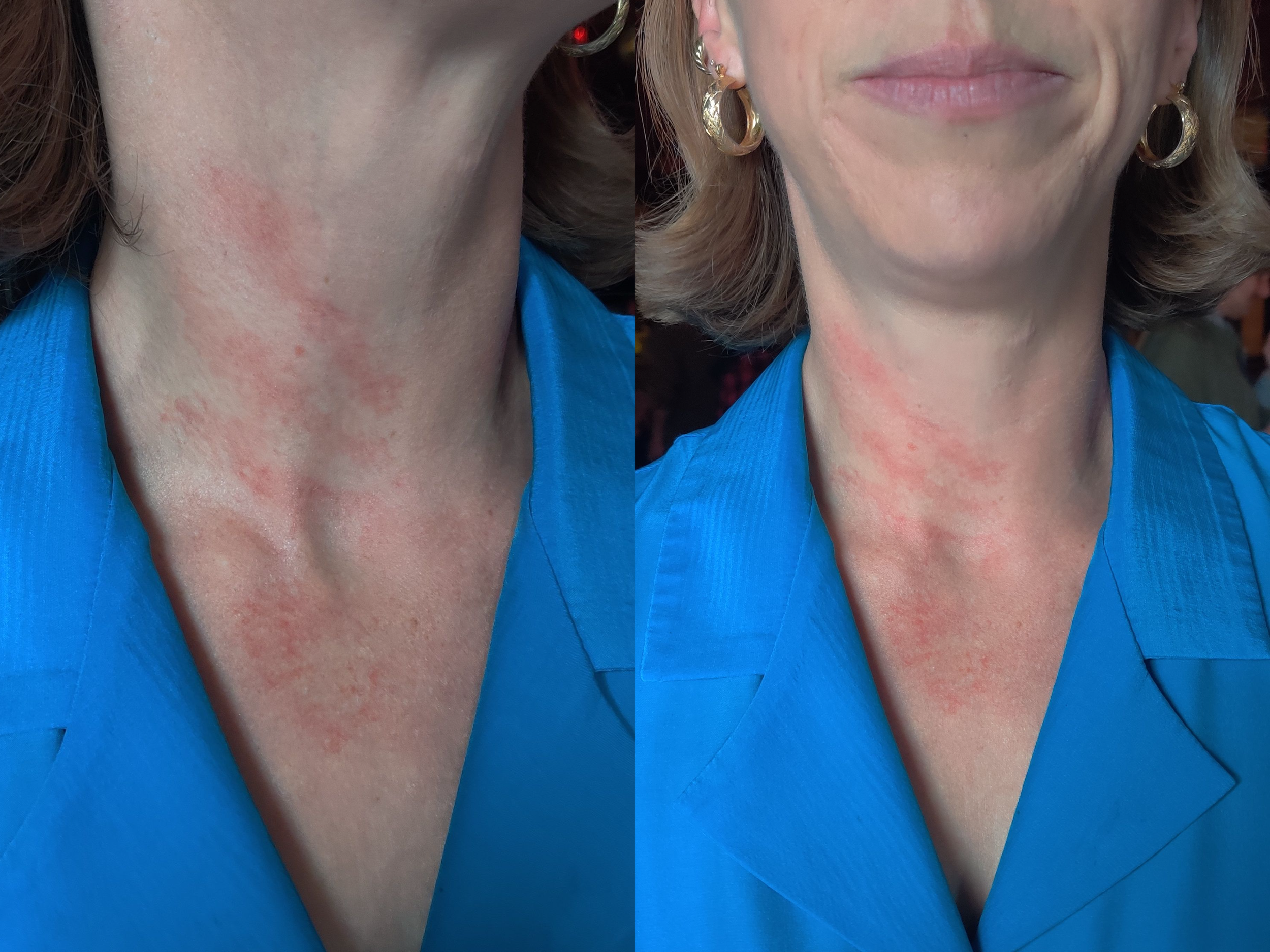 neck bruise_erythema.png