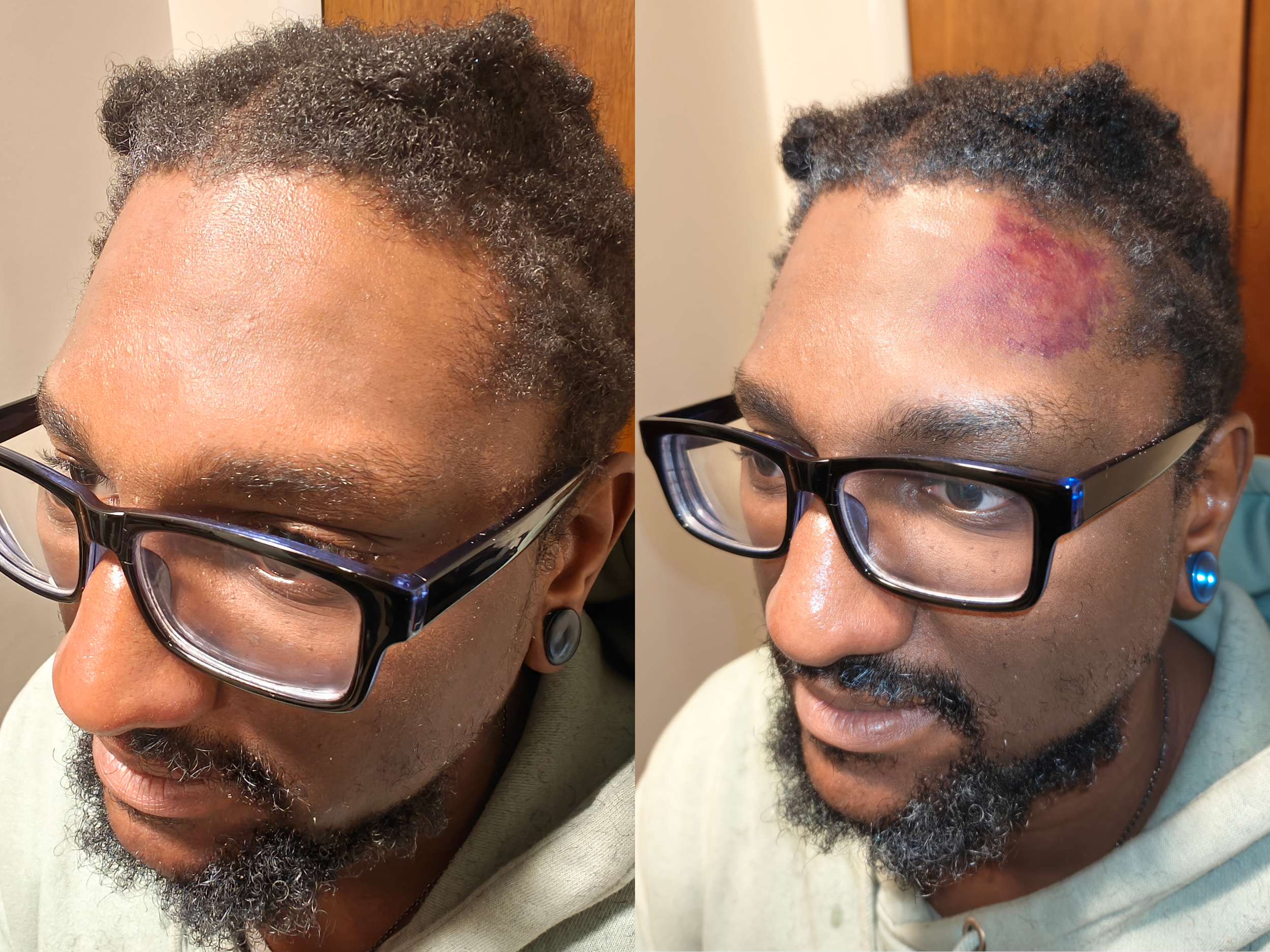 Standard Bruise on Dark Skin